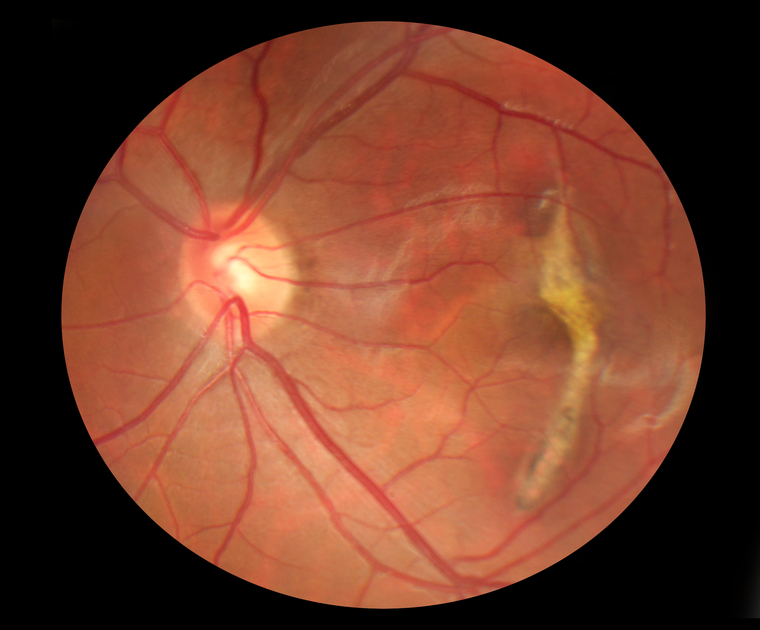 optomap retinal exam article